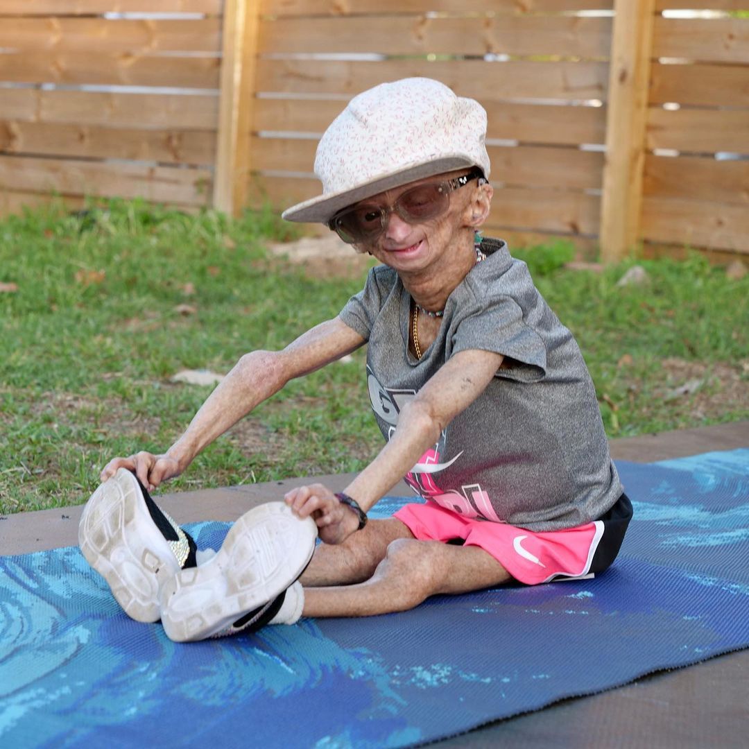 Erken yaşlanan ünlü Youtuber'dan acı haber! Adalia Rose Williams 15 yaşında hayatını kaybetti 21