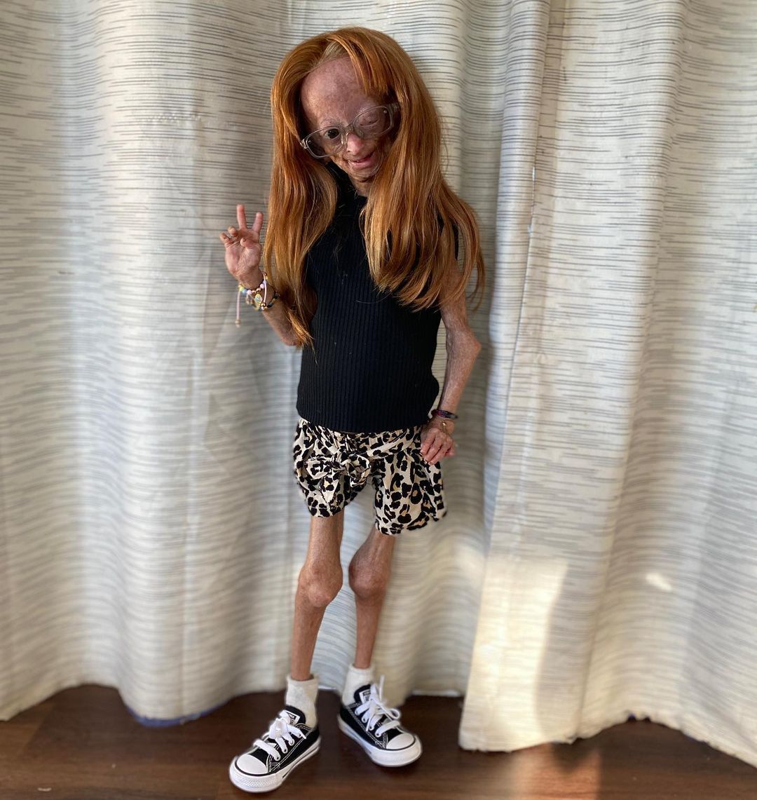 Erken yaşlanan ünlü Youtuber'dan acı haber! Adalia Rose Williams 15 yaşında hayatını kaybetti 26