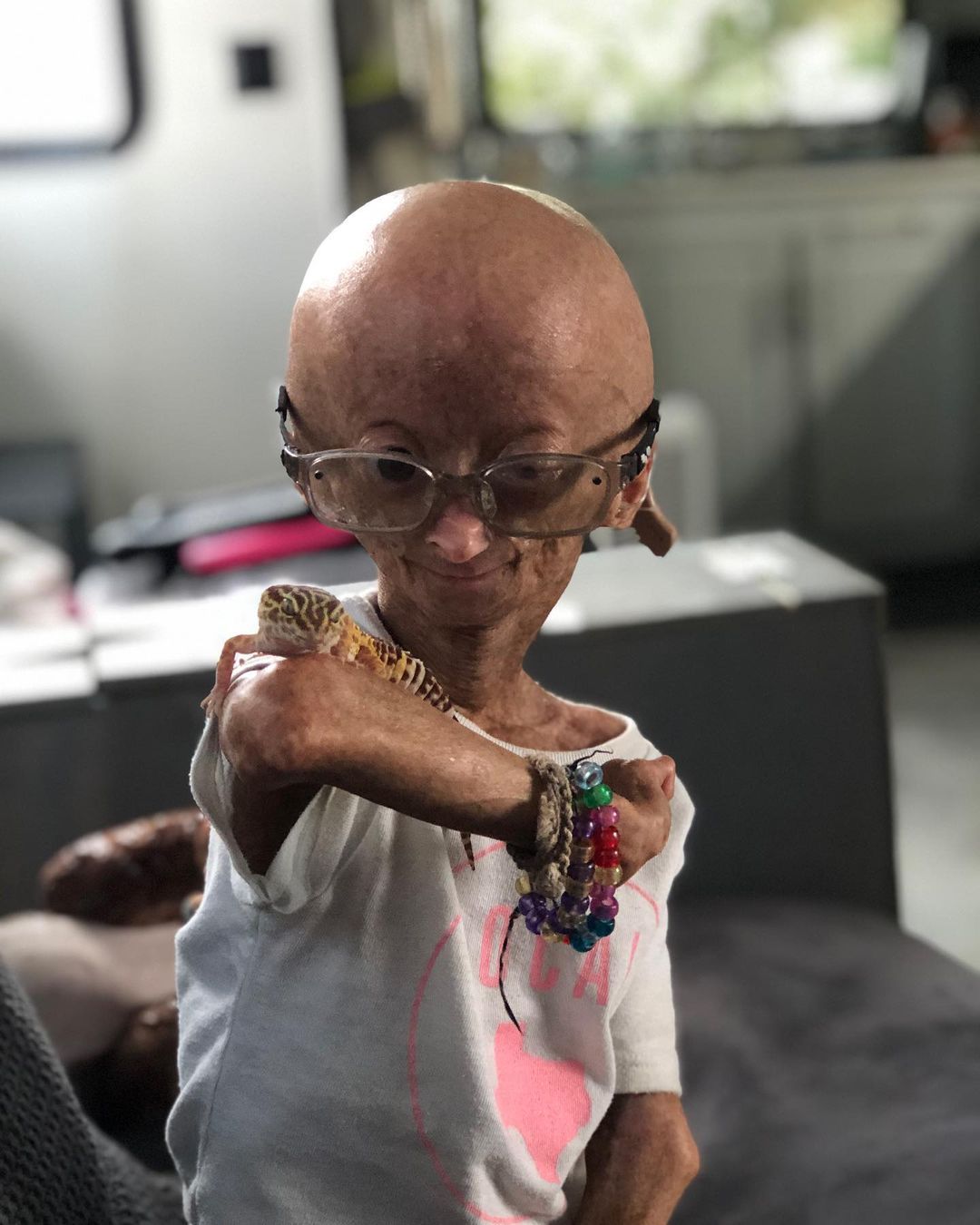 Erken yaşlanan ünlü Youtuber'dan acı haber! Adalia Rose Williams 15 yaşında hayatını kaybetti 2