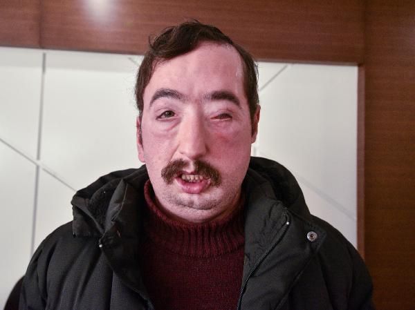 Türkiye'nin ilk yüz naklinin 10. yıl dönümü pasta ile kutlandı! İşte Uğur Acar ve Turan Çolak'ın son hali... 6