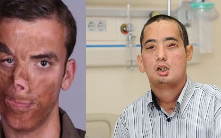 Türkiye'nin ilk yüz naklinin 10. yıl dönümü pasta ile kutlandı! İşte Uğur Acar ve Turan Çolak'ın son hali... 1