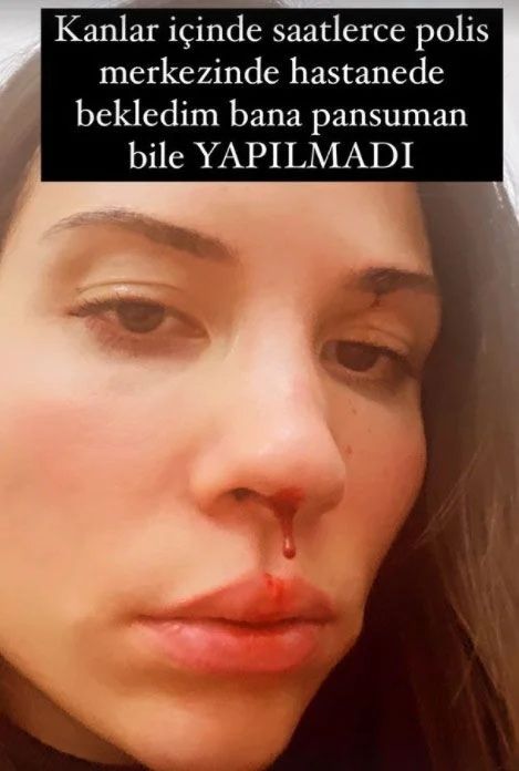 Özer Hurmacı'nın Eşi Mihriban Hurmacı Yaşadığı Skandal Darp Görüntülerini Paylaştı! 3