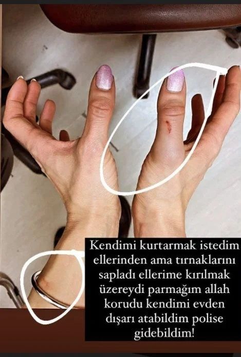Özer Hurmacı'nın Eşi Mihriban Hurmacı Yaşadığı Skandal Darp Görüntülerini Paylaştı! 4