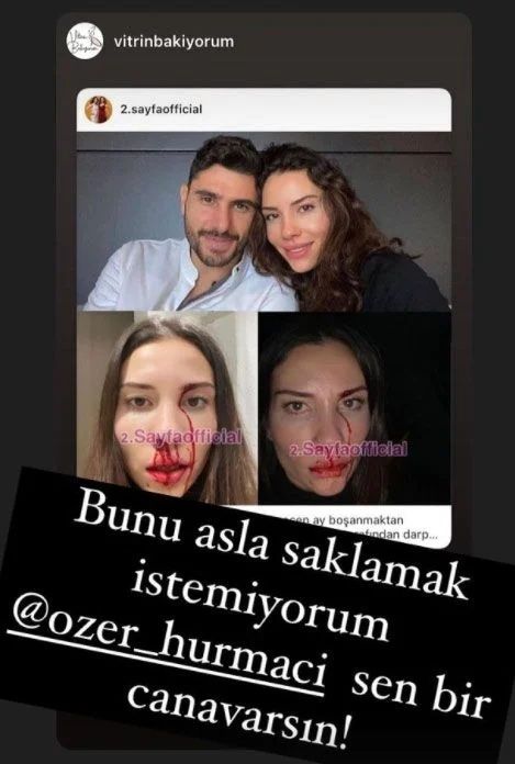 Özer Hurmacı'nın Eşi Mihriban Hurmacı Yaşadığı Skandal Darp Görüntülerini Paylaştı! 5