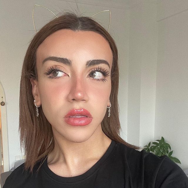 Sosyal medya fenomeni Mika Can Raun estetik operasyon geçirdi! Bambaşka bir yüze sahip oldu 28