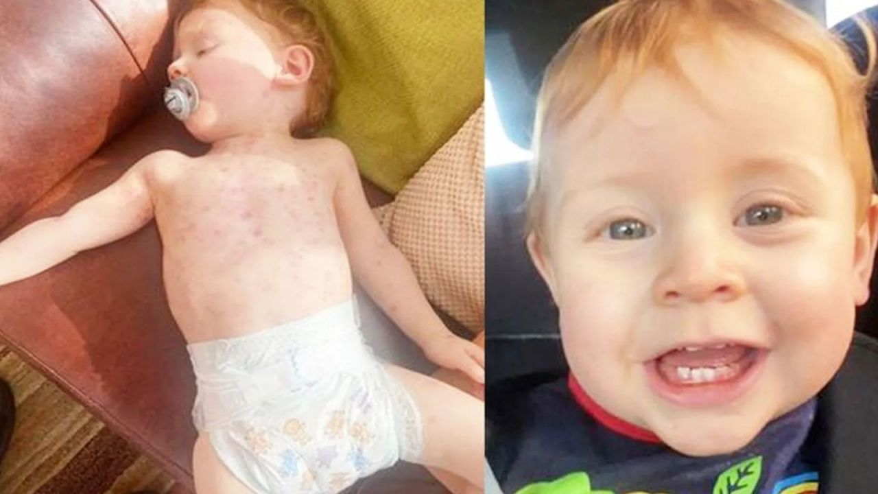 Annesi kızamık zannetti, gerçek bambaşka çıktı: Parmaklarını kaybedebilir! 4