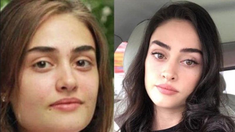Ünlülerin hayatlarını estetik değiştirdi! Pınar Deniz, Gülsüm Ali, Melek Mosso estetiksiz halleri 4