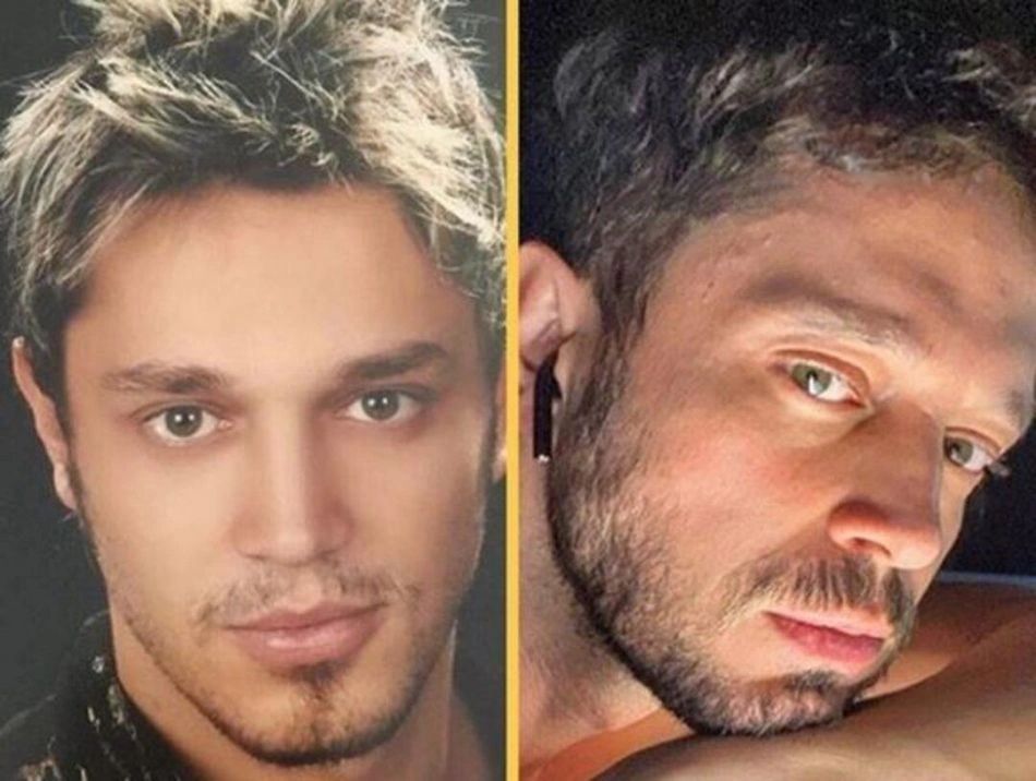 Ünlülerin hayatlarını estetik değiştirdi! Pınar Deniz, Gülsüm Ali, Melek Mosso estetiksiz halleri 11