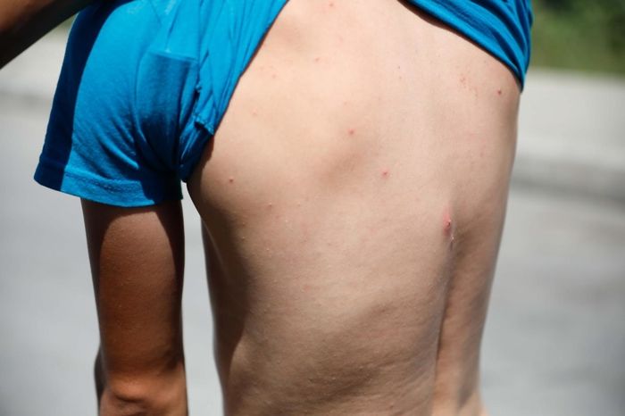 İstanbul'da 'Aedes' sineği alarmı: Zika virüsü bulaştırıyor! İlaçlamak da yeterli değil... 3