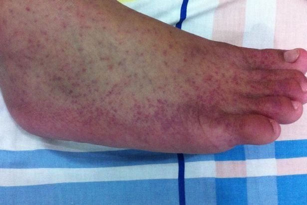 Yeni salgın alarmı: Domates gribi! Özellikle çocukları etkiliyor... İşte belirtileri... 5