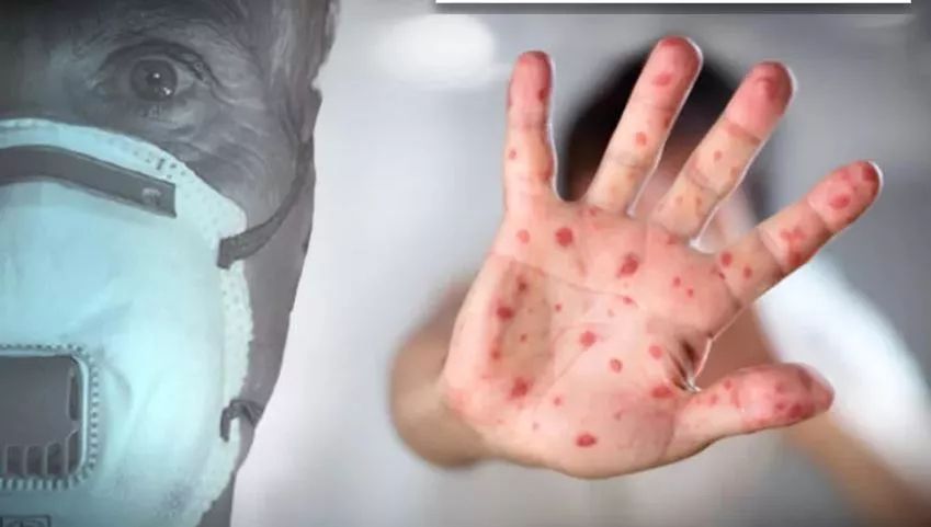 Yeni salgın alarmı: Domates gribi! Özellikle çocukları etkiliyor... İşte belirtileri... 4
