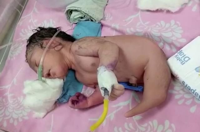 Yeni doğan bebeği gören doktorlar hayrete düştü! 2