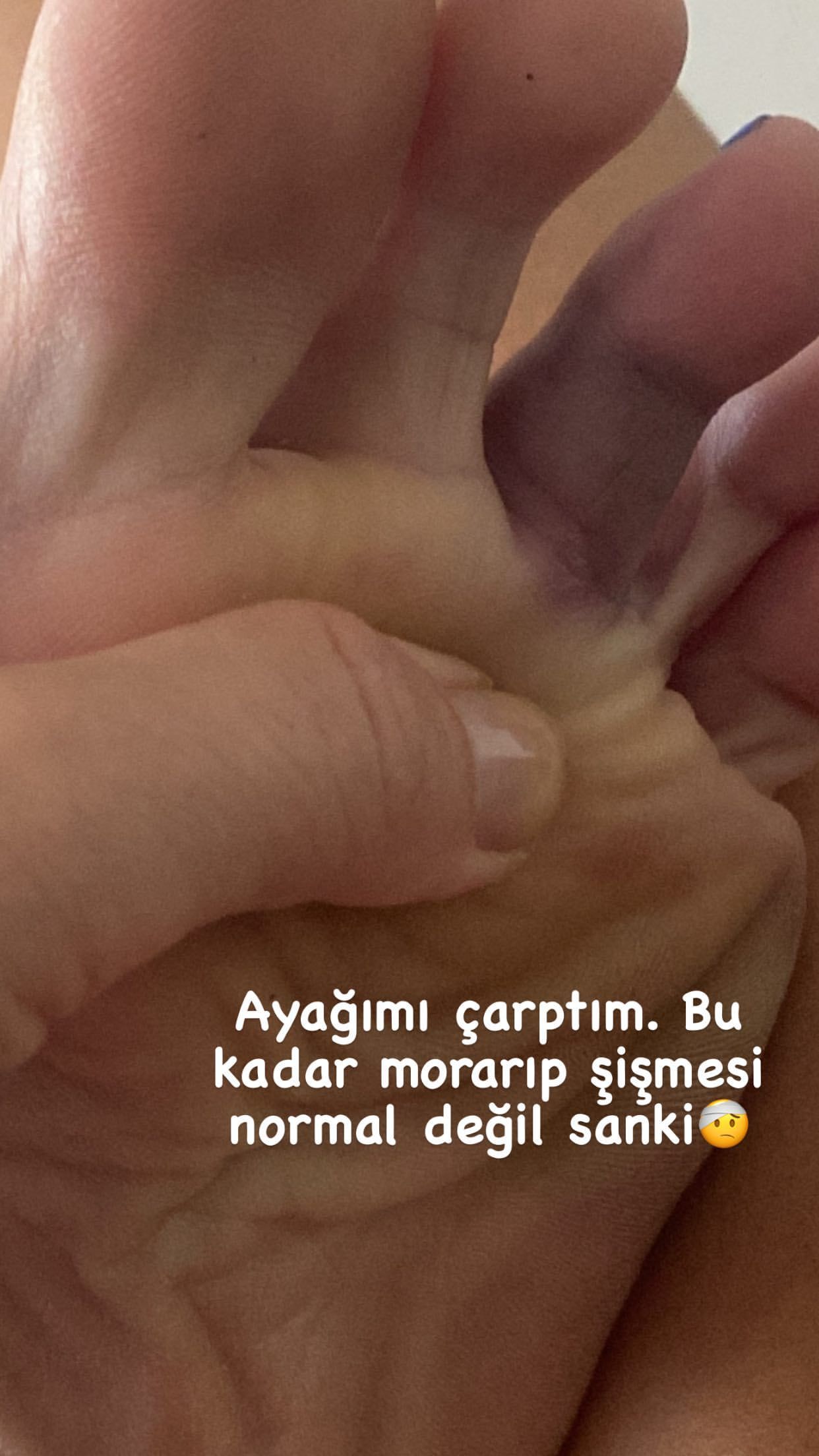 Hastane odasından paylaştı... Begüm Kütük ev kazası geçirdi! 3