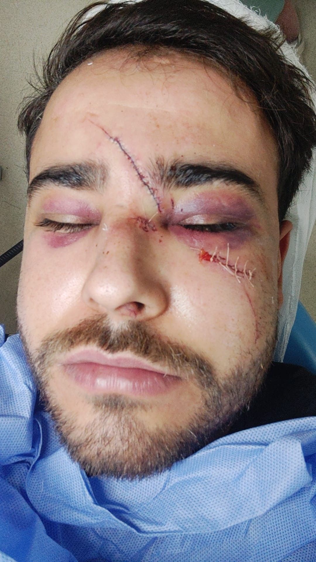Hatay’da istek şarkıyı bilmeyen müzisyenin yüzünde şişe kırdılar 4