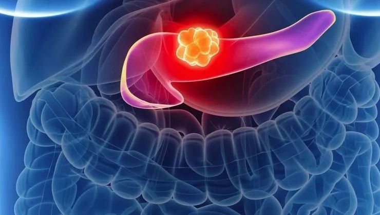 Pankreas kanseri ile ilgili en çok merak edilen sorular ve cevapları 3