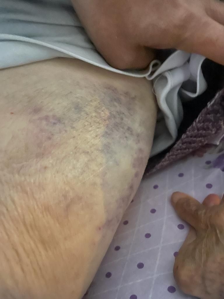 Ankara'da bakıcı dehşeti! Yaşlı kadının başından aşağı sıcak yemek döktü! 5