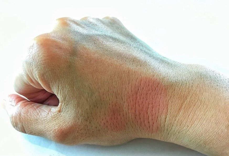 Dilan Polat'ın hastalığı Lupus hastalığı hakkında merak edilenler! 5