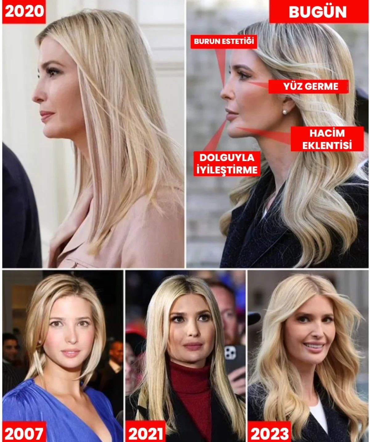 Donald Trump'ın kızı Ivanka Trump yüzündeki değişimle gündem oldu! Estetik operasyonlarıyla güzelliğine güzellik kattı 7