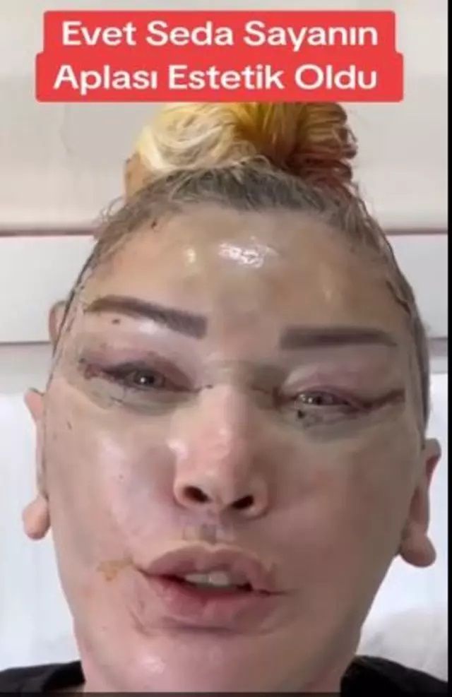 Onlarca operasyon geçiren Seda Sayan, ablası Nursel Yıldız'a da estetik yaptırdı! Son hali şoke etti 6
