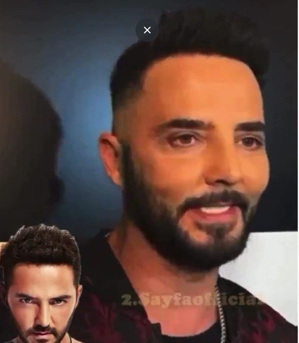 Gökhan Özen'in yüzündeki değişim sosyal medya kullanıcılarının dilinde! 4