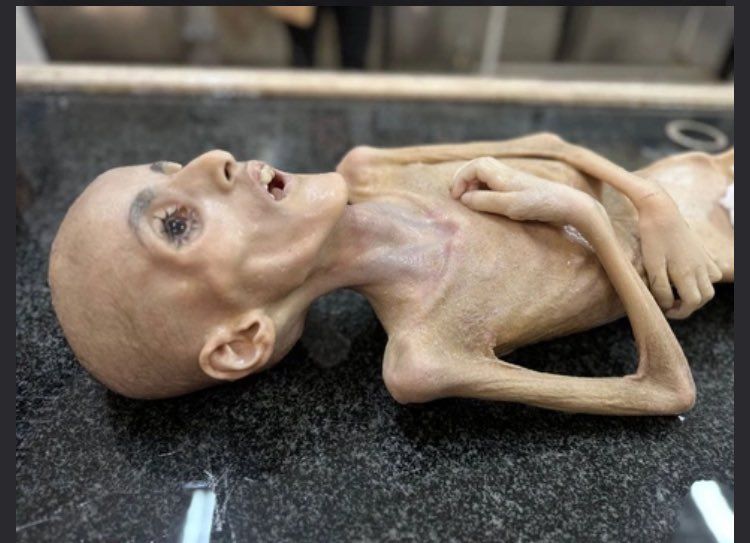 Gazze'de trajedinin fotoğrafı... Filistinli Yezen el-Kefarne yetersiz beslenme nedeniyle hayatını kaybetti 5