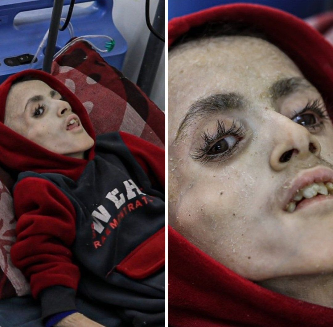 Gazze'de trajedinin fotoğrafı... Filistinli Yezen el-Kefarne yetersiz beslenme nedeniyle hayatını kaybetti 8