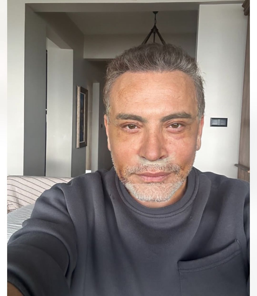 Cenk Eren yüzünü gerdirdi! Son hali sosyal medya kullanıcılarını ikiye böldü 2
