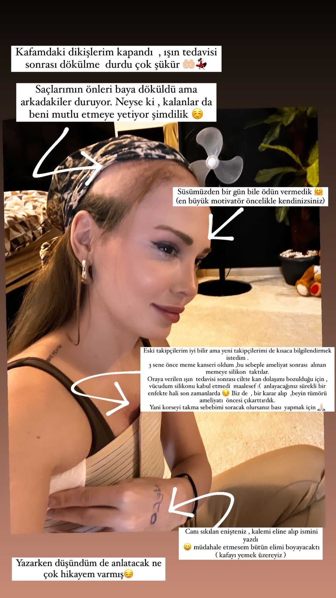 Meme kanserini yenip beyin tümörüne yakalanmıştı! Işın tedavisi gören Şimal son halini paylaştı! 'Dikişlerim kapandı...' 11
