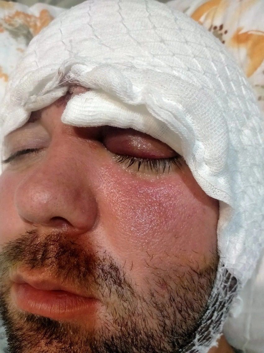 Bursa’da diş ameliyatında vahşet! Beynine vida saplandı 5