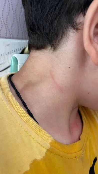 Karaman'da öğretmen dehşeti! Öğrencisini kaynar suyla haşlayıp başını duvara vurdu! 3