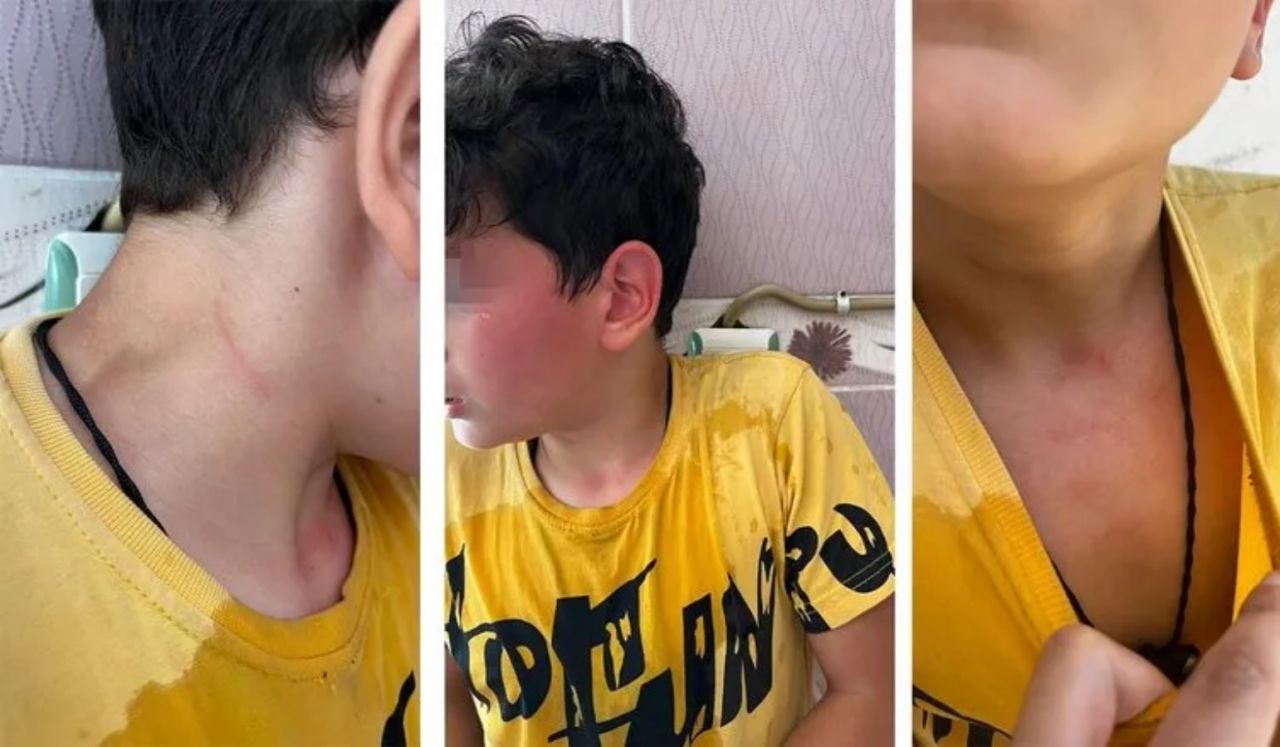 Karaman'da öğretmen dehşeti! Öğrencisini kaynar suyla haşlayıp başını duvara vurdu! 6