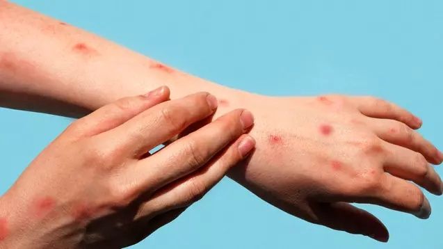 Afrika'da başlayıp Avrupa'da görülen Maymun Çiçeği virüsü Asya'ya sıçradı! Pakistan'da tespit edildi... 5