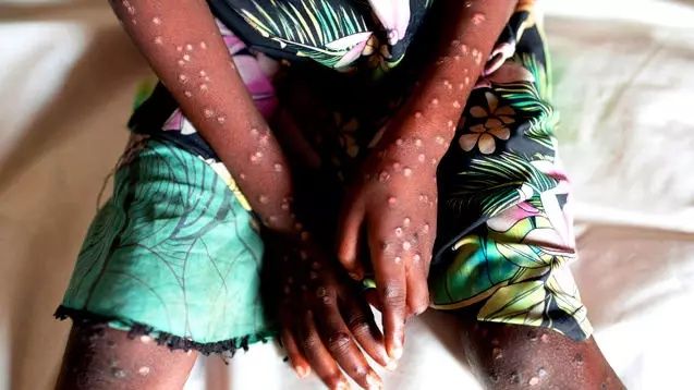 Afrika'da başlayıp Avrupa'da görülen Maymun Çiçeği virüsü Asya'ya sıçradı! Pakistan'da tespit edildi... 10
