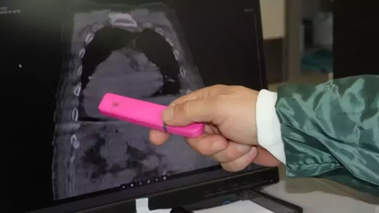 Dünyada bir ilk! Tüm organları yer değiştiriyor... Hastalığa 'Giresun Sendromu' ismi verildi! 2