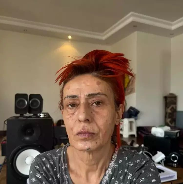 Yüzünde kimyasal yanıklar oluşmuştu! İşte Yıldız Tilbe'nin son hali 3