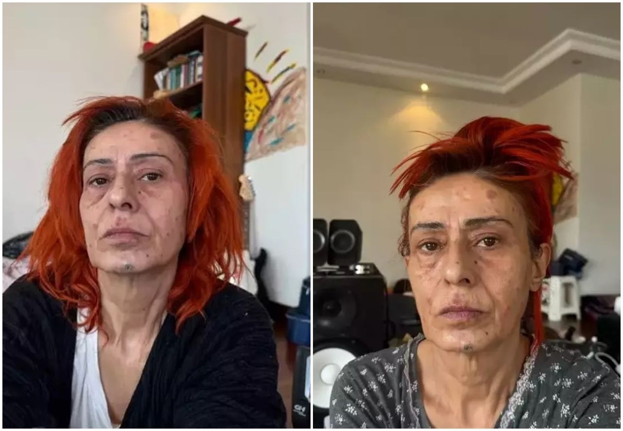 Saç boyası krizi! Yıldız Tilbe, ‘Uyuduğu için yüzü yandı’ iddialarına cevap verdi: Boya kötüymüş! 1