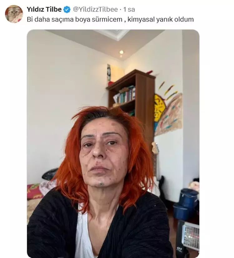 Saç boyası krizi! Yıldız Tilbe, ‘Uyuduğu için yüzü yandı’ iddialarına cevap verdi: Boya kötüymüş! 2