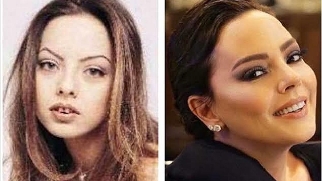 Ünlülerin yıllar içindeki değişimine inanamayacaksınız! Sanki yıllar geçmemiş gibi! İşte ünlülerin estetikli halleri... 6