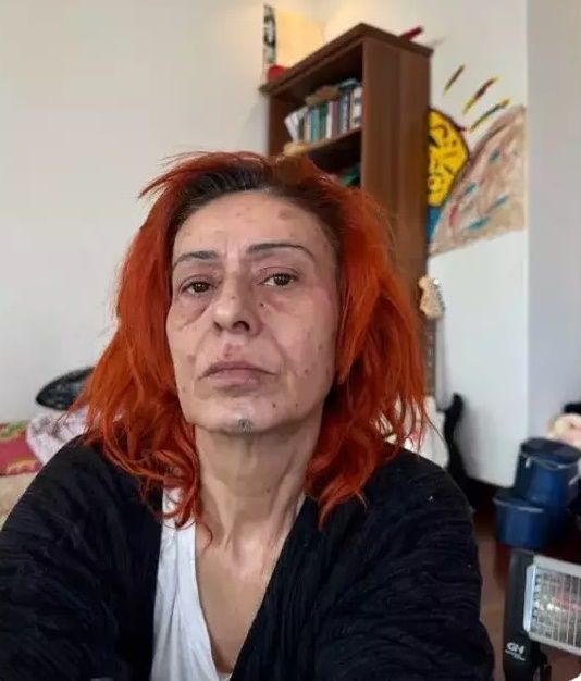 Yıldız Tilbe’nin yüzündeki kimyasal yanıkla ilgili yeni gelişme 3