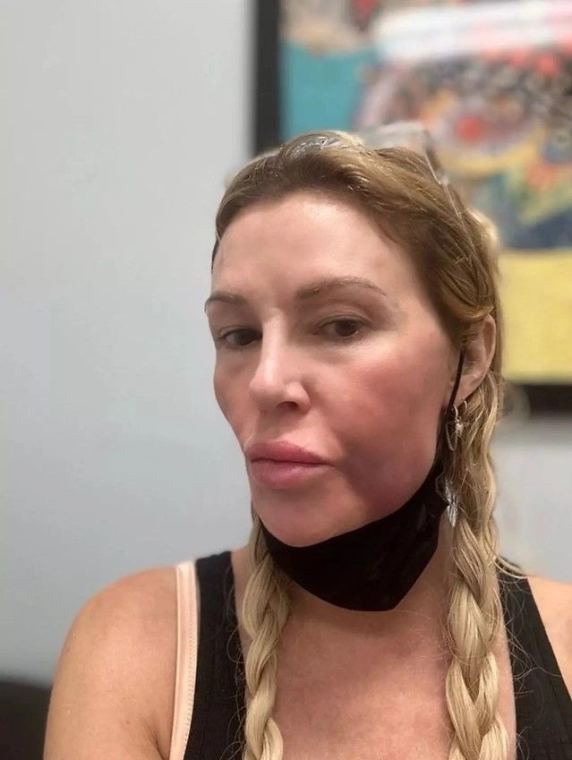 Estetik ve makyaj tutkusu Brandi Glanville'nin kabusu oldu! Suratında mantar ve parazit oluşan ünlü modelin son hali şaşkına çevirdi 2
