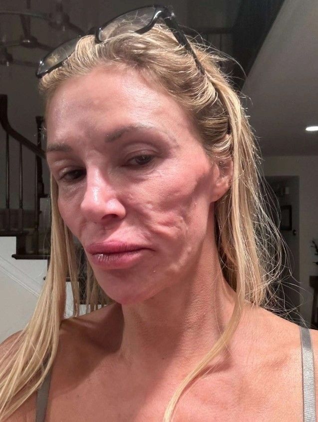 Estetik ve makyaj tutkusu Brandi Glanville'nin kabusu oldu! Suratında mantar ve parazit oluşan ünlü modelin son hali şaşkına çevirdi 3