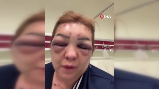 Botoks rüyası kabusa döndü! Güzelleşeceğim diye tanınmaz hale geldi! 1