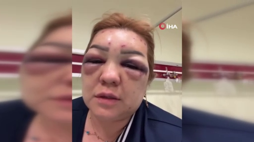 Botoks rüyası kabusa döndü! Güzelleşeceğim diye tanınmaz hale geldi! 2