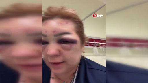 Botoks rüyası kabusa döndü! Güzelleşeceğim diye tanınmaz hale geldi! 4