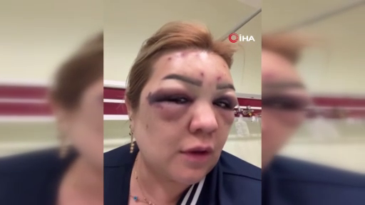Botoks rüyası kabusa döndü! Güzelleşeceğim diye tanınmaz hale geldi! 5
