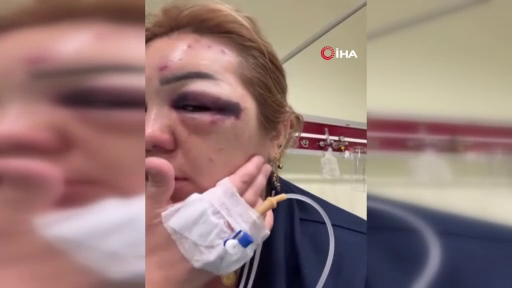 Botoks rüyası kabusa döndü! Güzelleşeceğim diye tanınmaz hale geldi! 6
