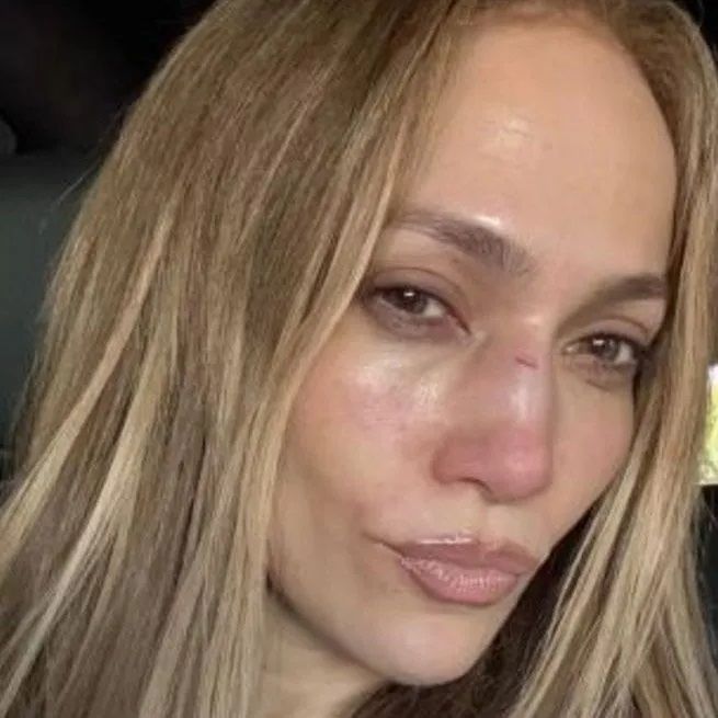 Jennifer Lopez, prova sırasında kaza geçirdi! Yüzüne dikiş atıldı 3