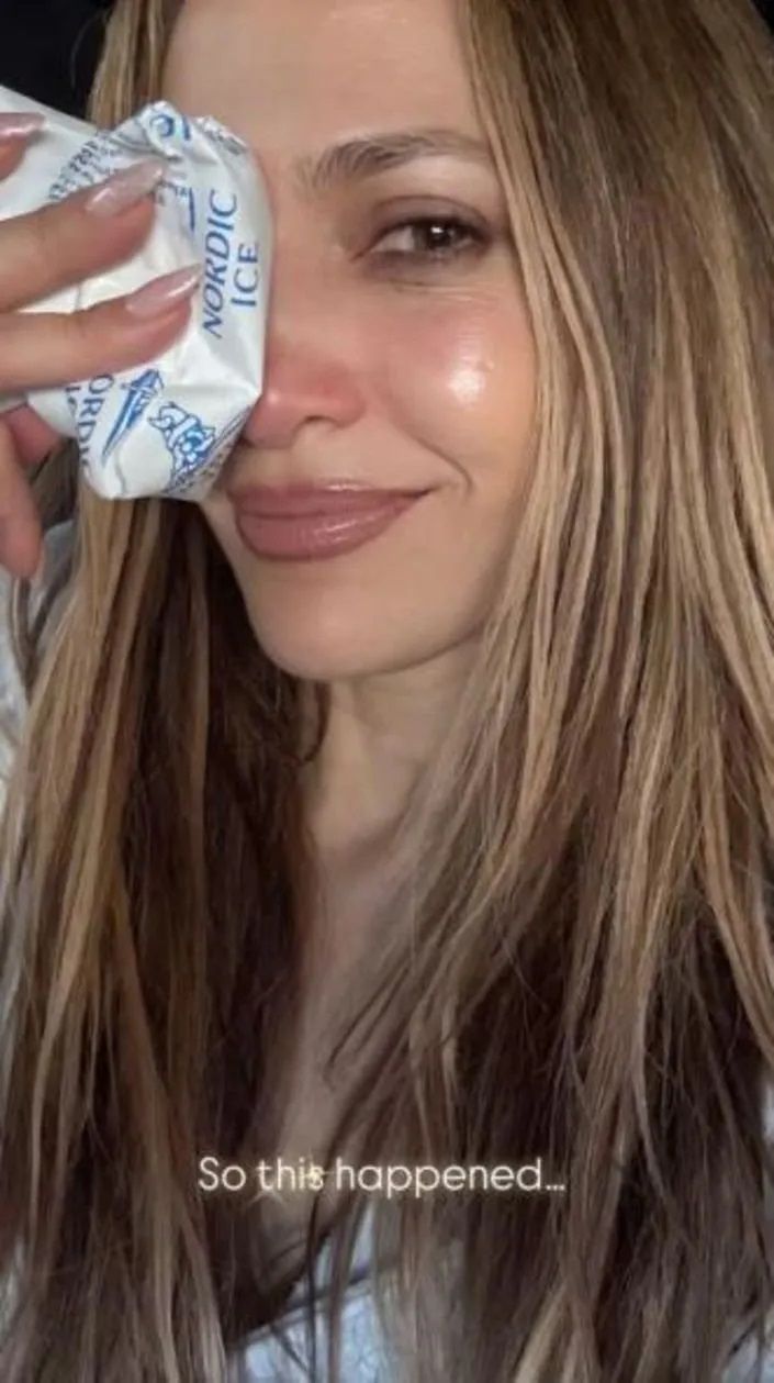 Jennifer Lopez, prova sırasında kaza geçirdi! Yüzüne dikiş atıldı 2