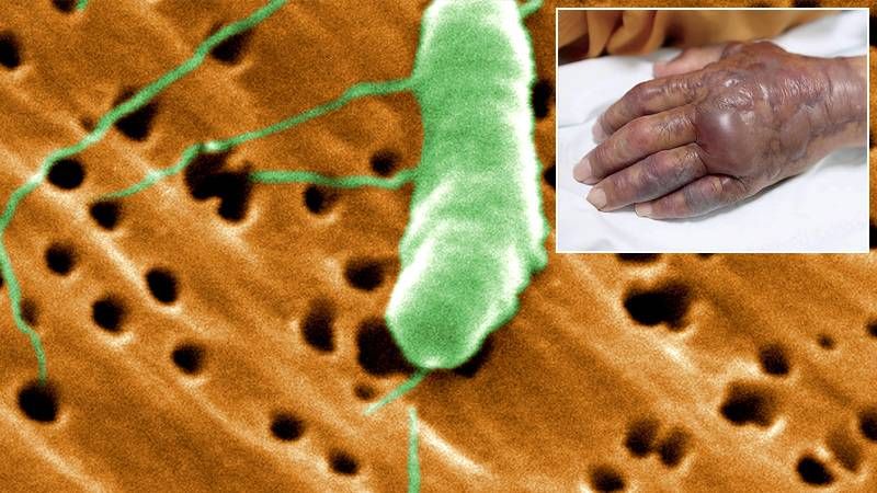 Et yiyen bakteri paniği! Sağlık Bakanlığı’ndan ‘Vibrio’ açıklaması: Türkiye’de vaka tespit edilmedi 6