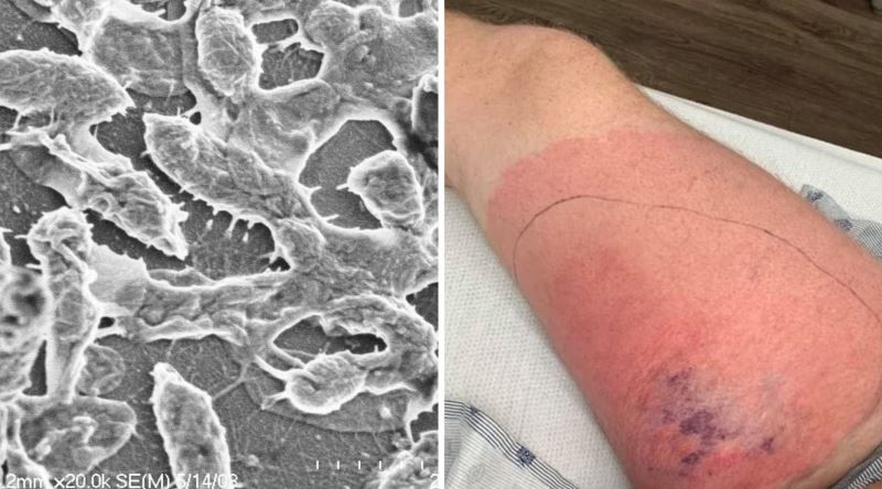 Et yiyen bakteri paniği! Sağlık Bakanlığı’ndan ‘Vibrio’ açıklaması: Türkiye’de vaka tespit edilmedi 3